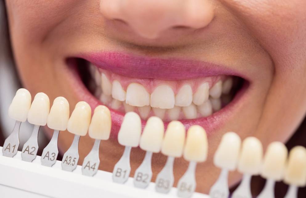 Idealny uśmiech na Nowy Rok licowki-na-zeby